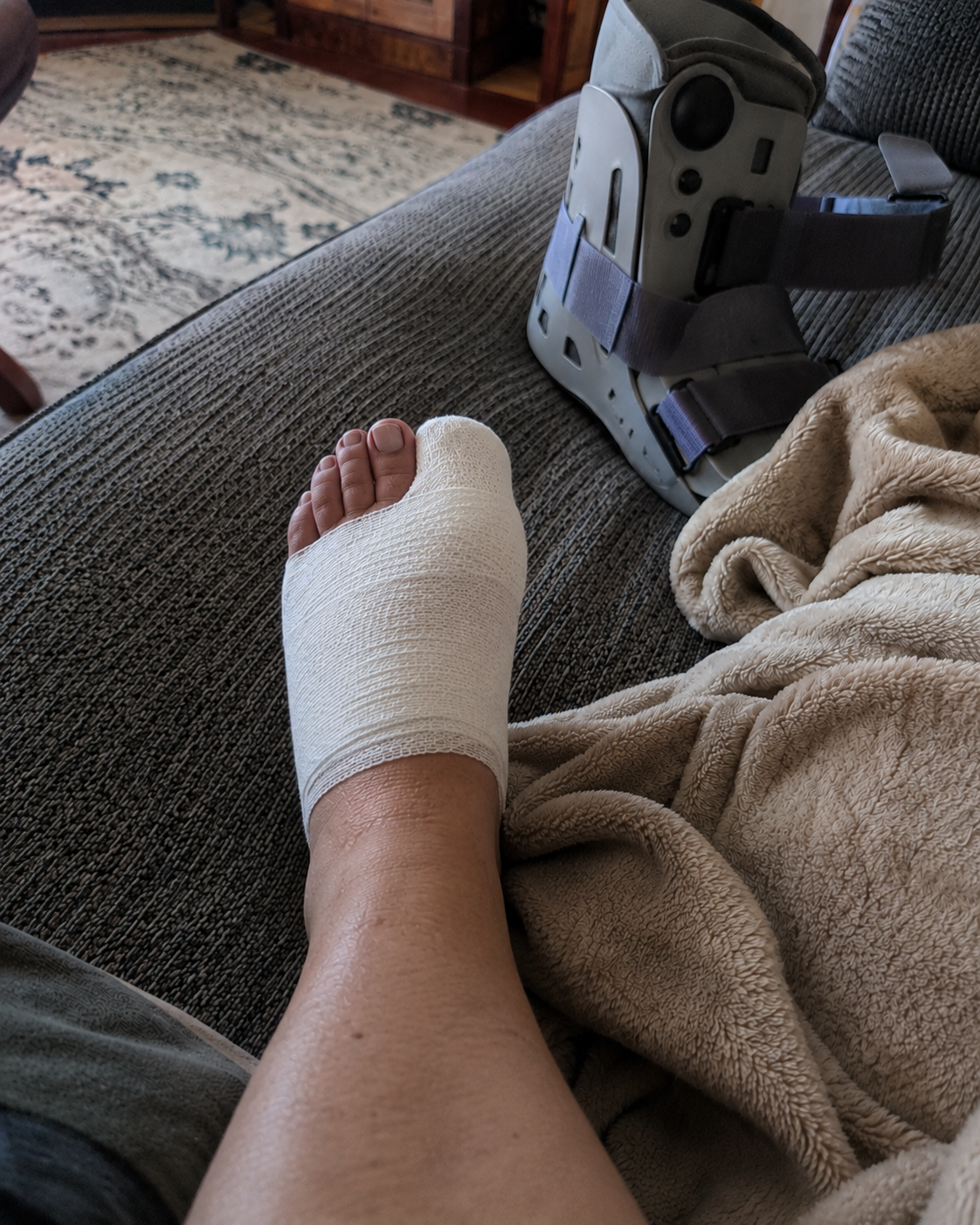 My foot after the operation
